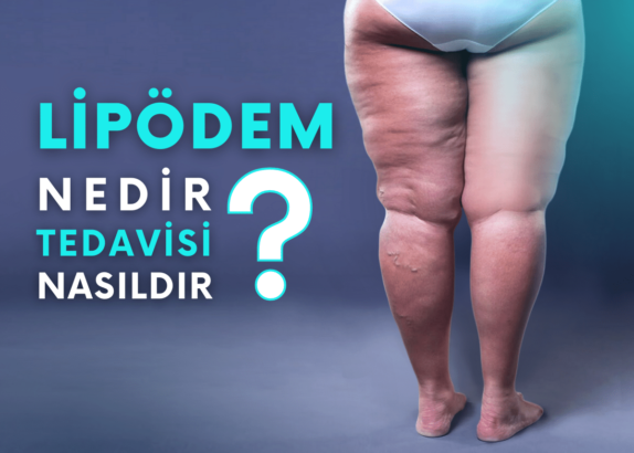 Kadınların Gizli Düşmanı: Lipödem!