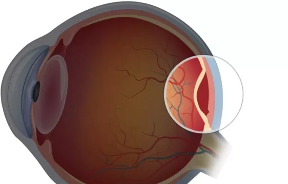 Retina dekolmanı körlüğe neden olabilir