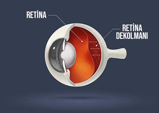 Retina dekolmanı körlüğe neden olabilir